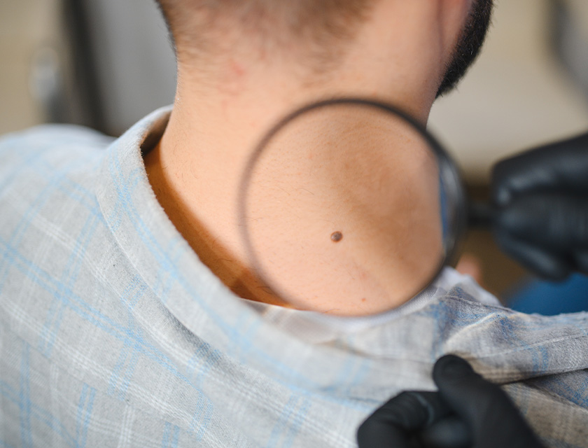 Skin Cancer Checks